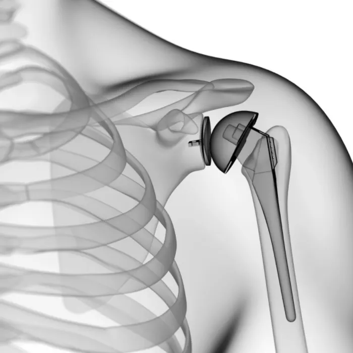 a protesi anatomica della spalla