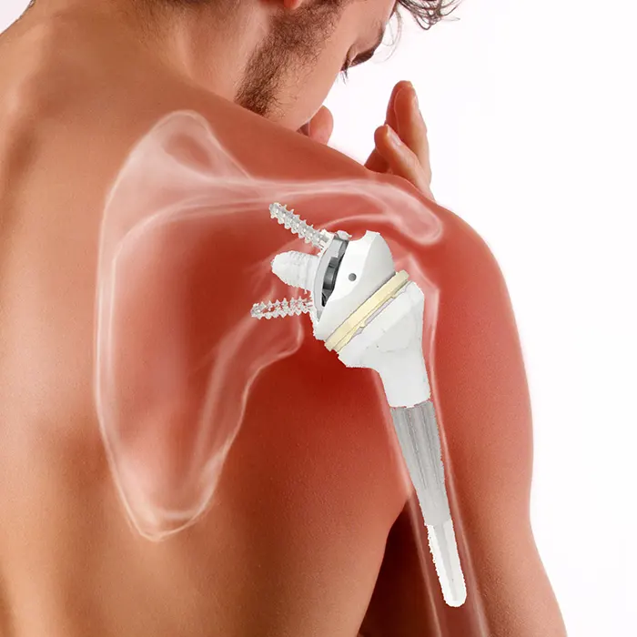 La protesi inversa della spalla